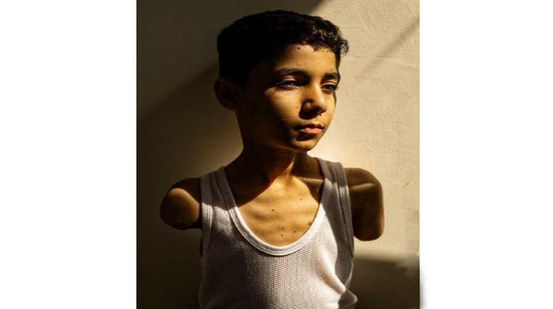 صورة طفل فلسطيني مبتور الأطراف تفوز بجائزة "وورلد برس فوتو" العالمية